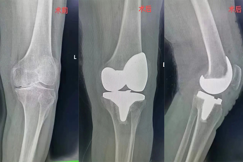 携手打造铮铮铁骨，长期病痛得消除