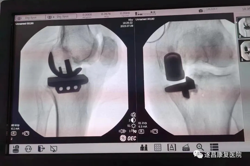 遂昌康复医院首例 ! 微创单髁置换，给七旬老人带来新“膝”望！