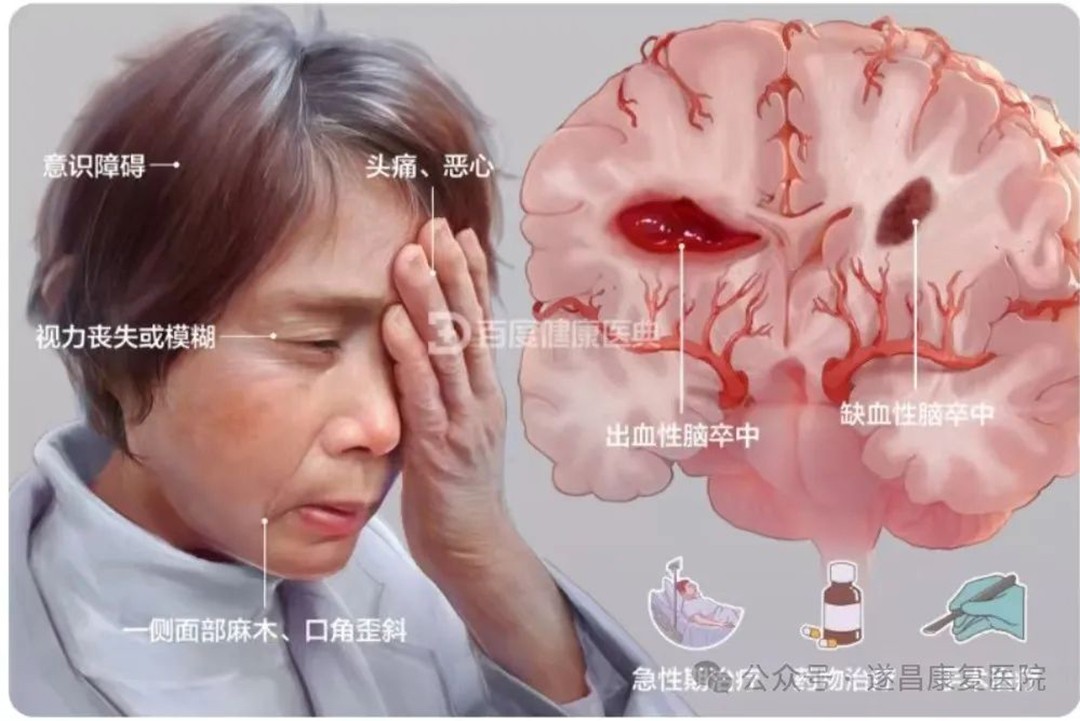 防中风~治中风//来遂昌康复医院！